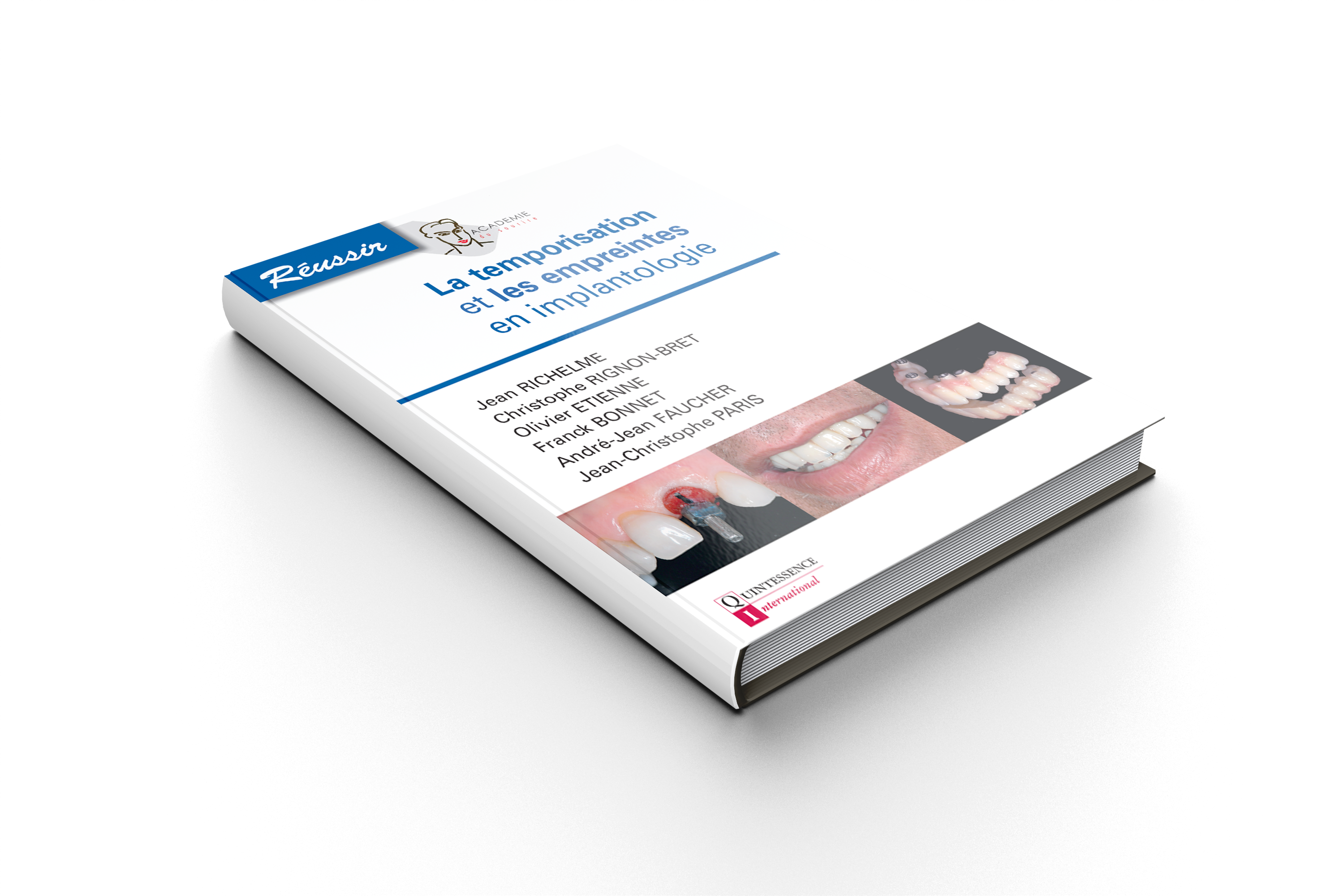 La temporisation et les empreintes en implantologie